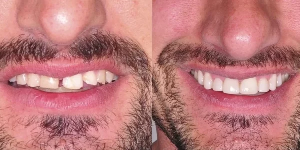 antes-y-despues-carillas-de-composite