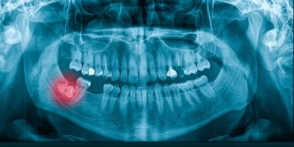 diente-impactado-1024x512