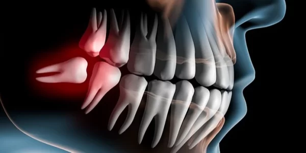 estudio-impactaciones-tercer-molar