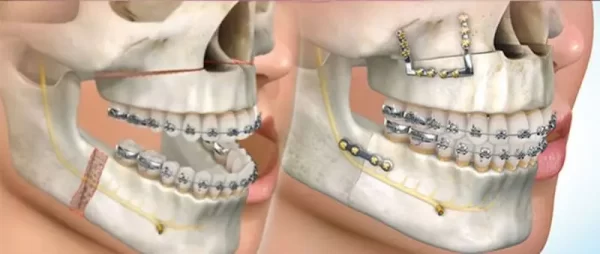 ortodoncia-quirurgica-2-_1_