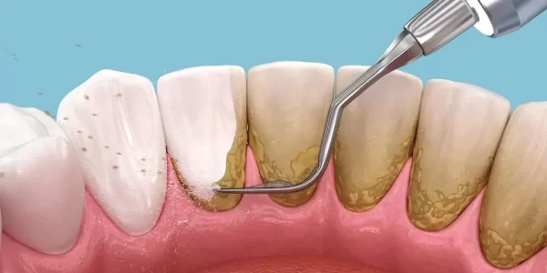 tartrectomia-periodoncia
